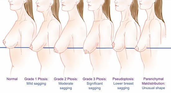 提乳或者提乳加上隆乳來改善胸部形狀