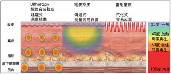 極線音波拉皮伴隨的好處