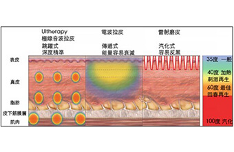 極線音波拉皮伴隨的好處