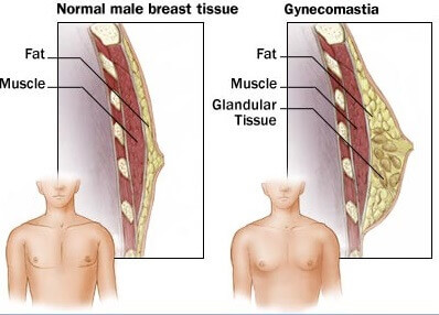 男性女乳症很多屬於混合型的，意指脂肪與腺體都存在