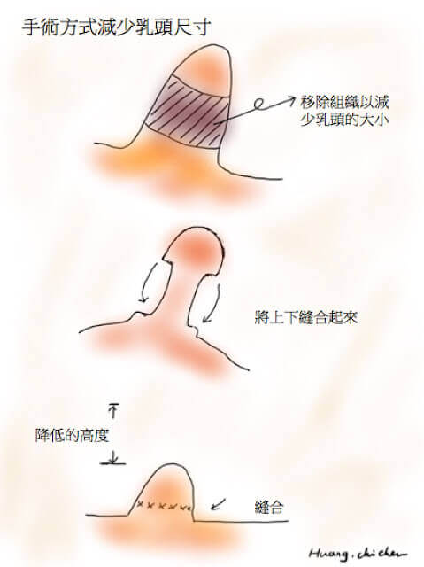 降低乳頭高度的方式