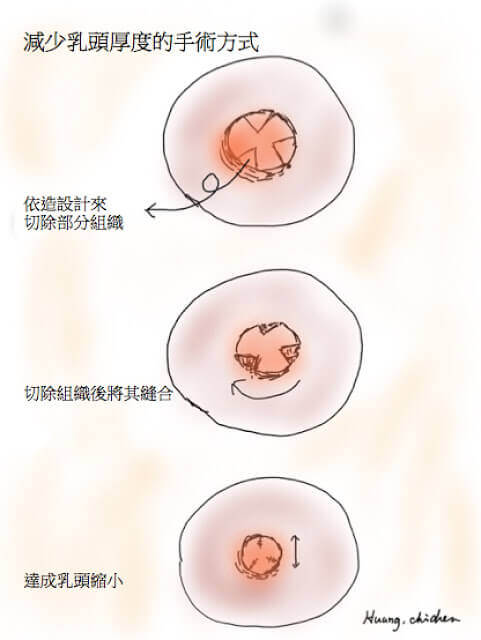 減少乳頭的直徑