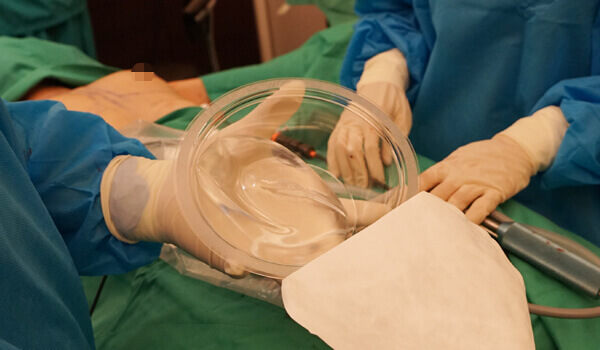 雙層水滴形隆乳手術