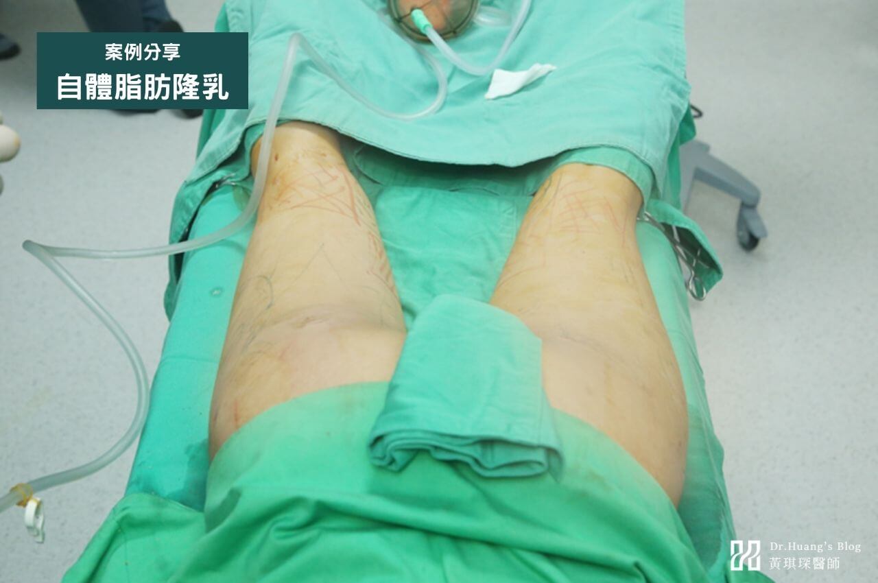 自體脂肪隆乳案例分享｜術前術後變化一次看
