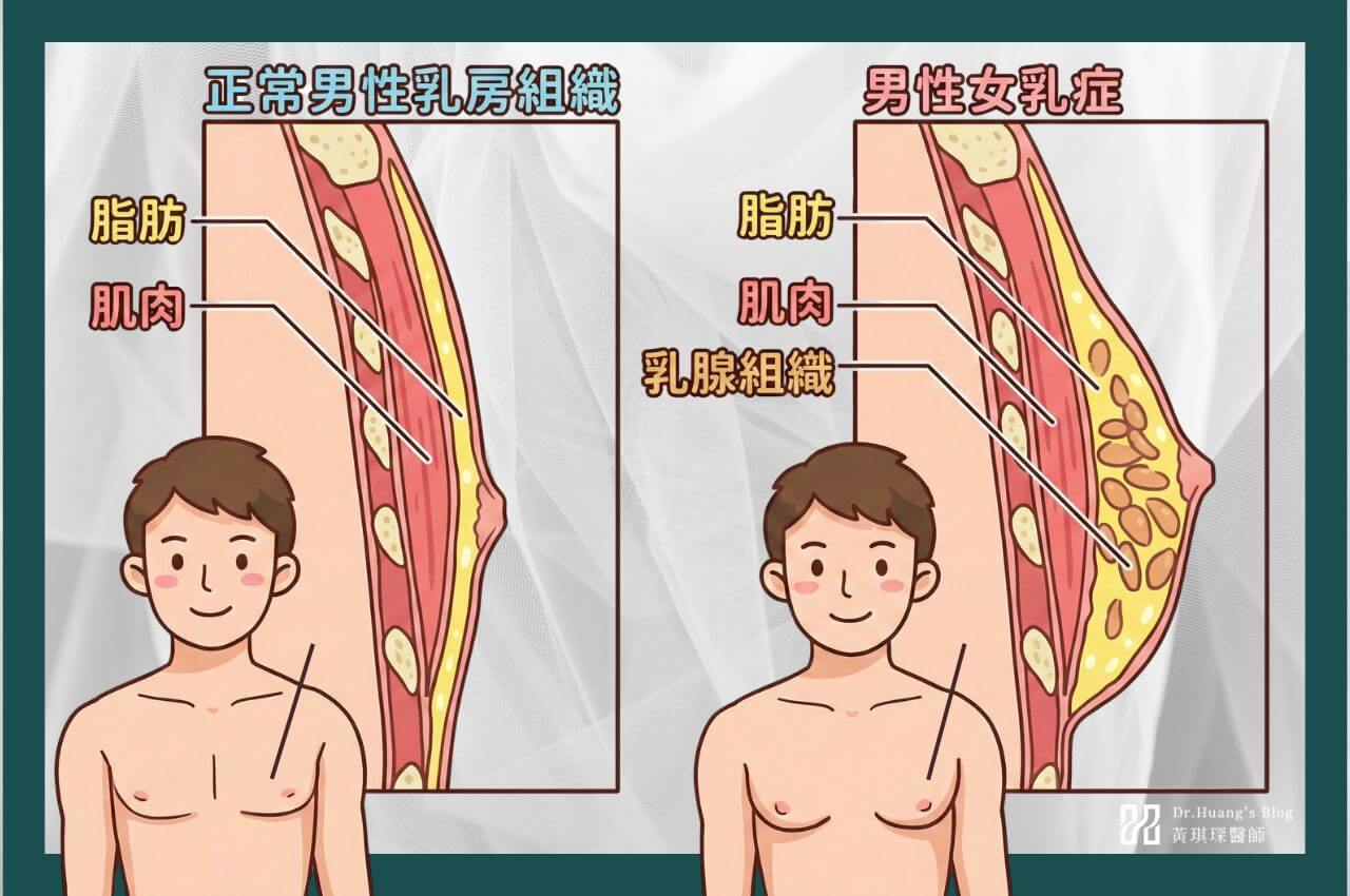 男性女乳症是什麼？