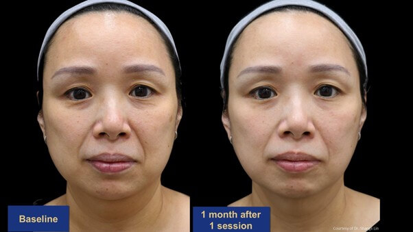 案例一:改善臉部膚質