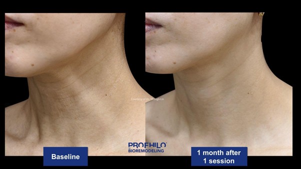 案例二:改善頸部緊緻度