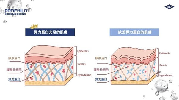 Profhilo逆時針效果與療程特點