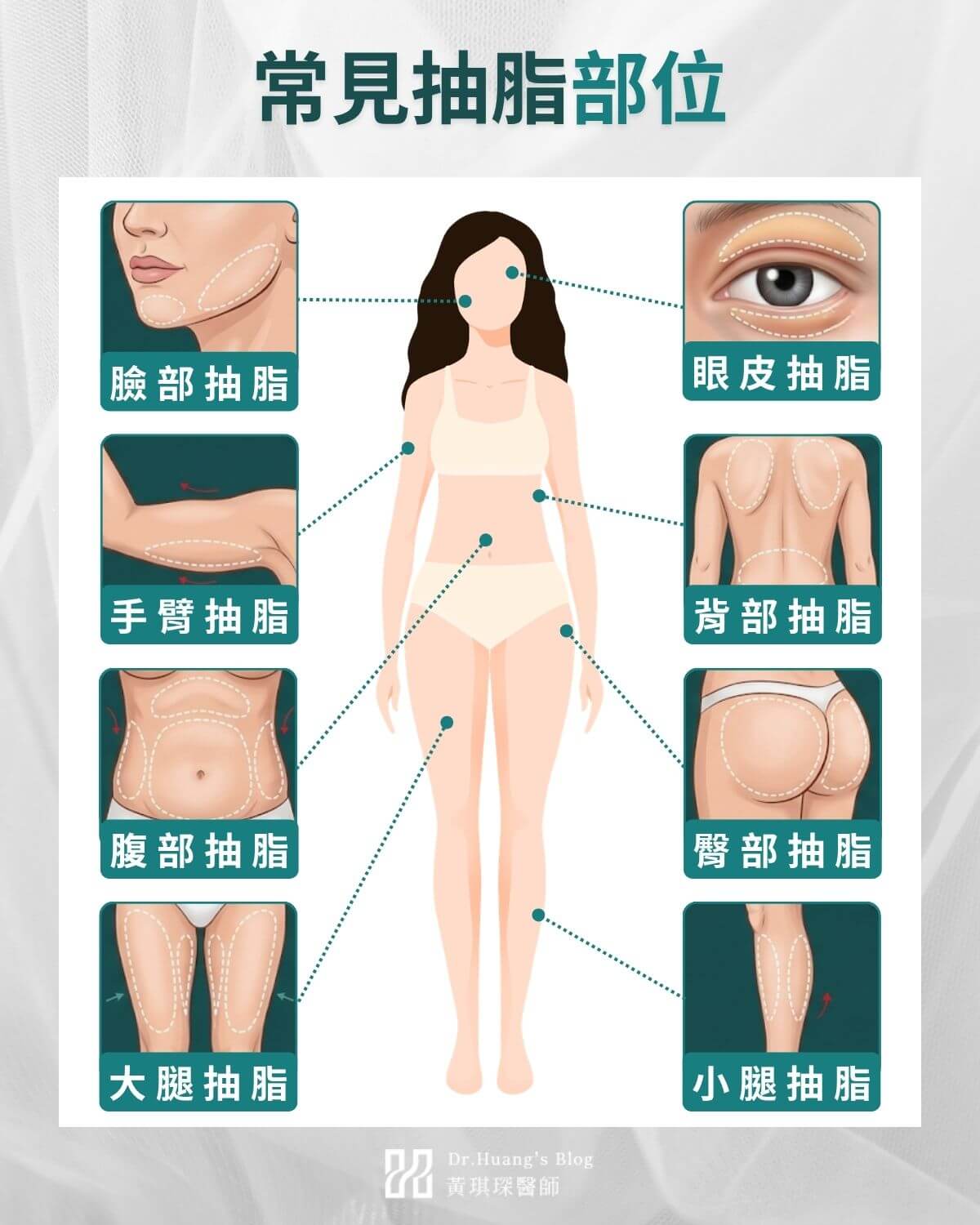 常見抽脂部位